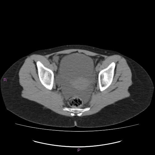 File:Acute pancreatitis secondary to stone at minor papilla and pancreatic divisum (Radiopaedia 76570-88333 Axial non-contrast 69).jpg