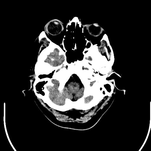 File:Acute pontine infarct from vertebral artery dissection (Radiopaedia 34111-35369 Axial non-contrast 4).png