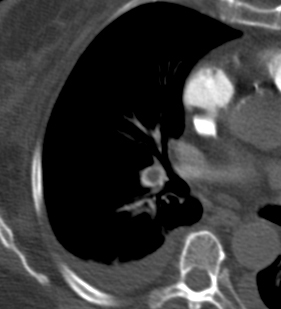 File:Acute pulmonary embolism (Radiopaedia 13286-13289 E 1).jpg