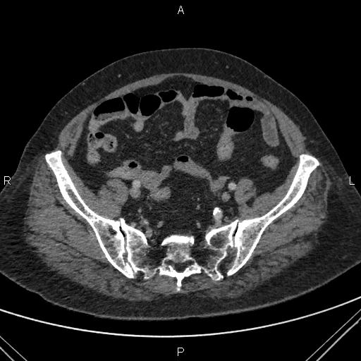 File:Acute renal artery occlusion (Radiopaedia 86586-102682 Axial C+ portal venous phase 76).jpg