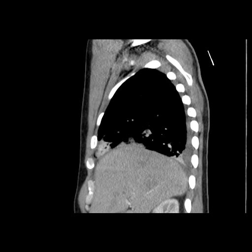 File:Acute segmental pulmonary emboli and pulmonary infarction (Radiopaedia 62264-70444 Sagittal C+ CTPA 18).jpg