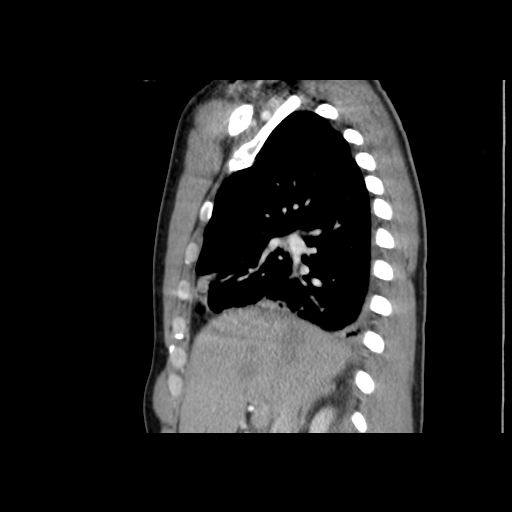 Acute segmental pulmonary emboli and pulmonary infarction (Radiopaedia 62264-70444 Sagittal C+ CTPA 24).jpg