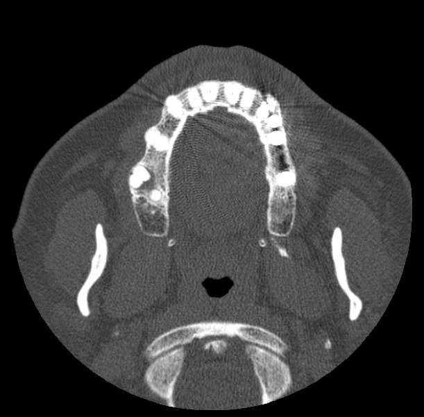 Acute sinusitis (Radiopaedia 23161-23215 Axial bone window 20).jpg