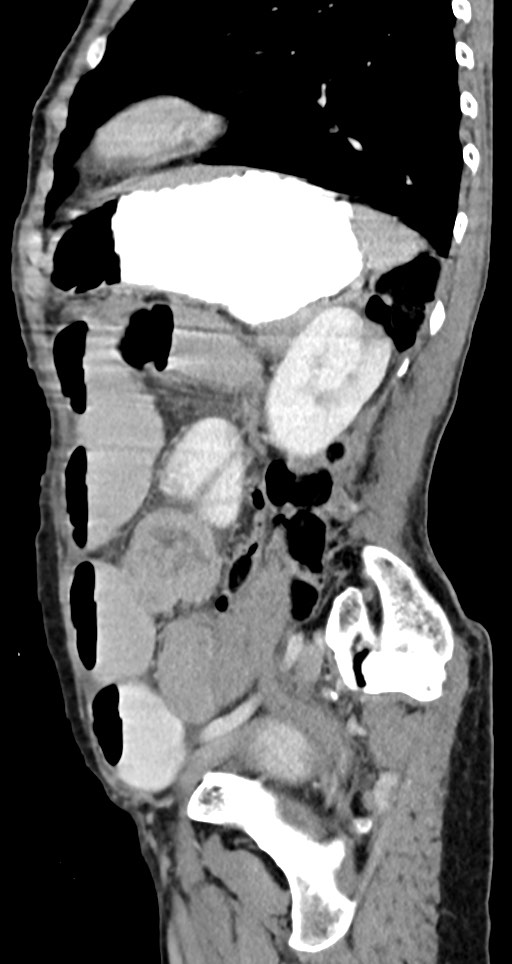 Acute small bowel (ileal) volvulus (Radiopaedia 71740-82139 Sagittal C+ portal venous phase 59).jpg