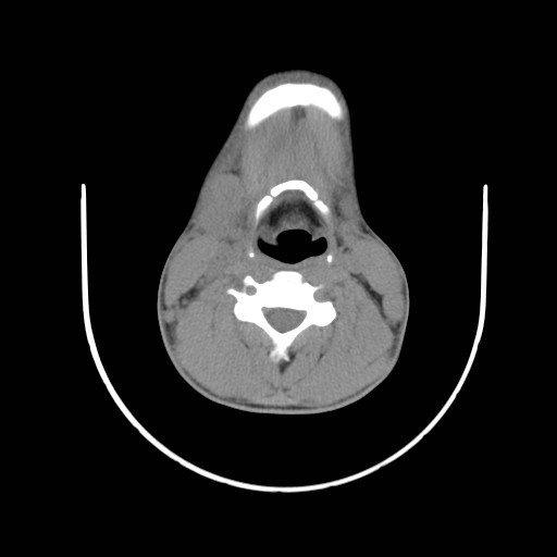 File:Acute submandibular sialadenitis secondary to ductal stone (Radiopaedia 27999-28267 Axial non-contrast 18).jpg