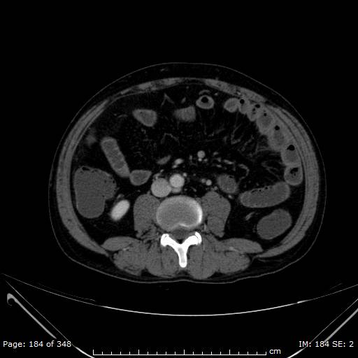 Acute superior mesenteric artery occlusion (Radiopaedia 43636-47060 Axial C+ portal venous phase 28).jpg