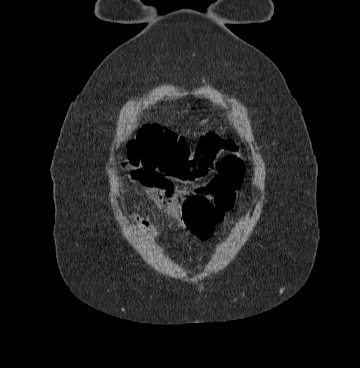 Acute superior mesenteric artery occlusion (Radiopaedia 51288-56960 Coronal C+ portal venous phase 8).jpg