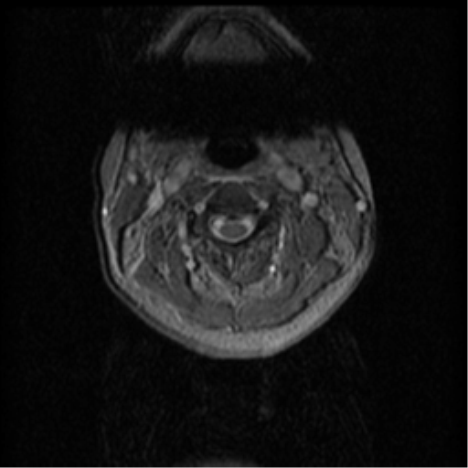 Acute traumatic non-hemorrhagic central cord syndrome (Radiopaedia 39562-41869 Axial Gradient Echo 53).png