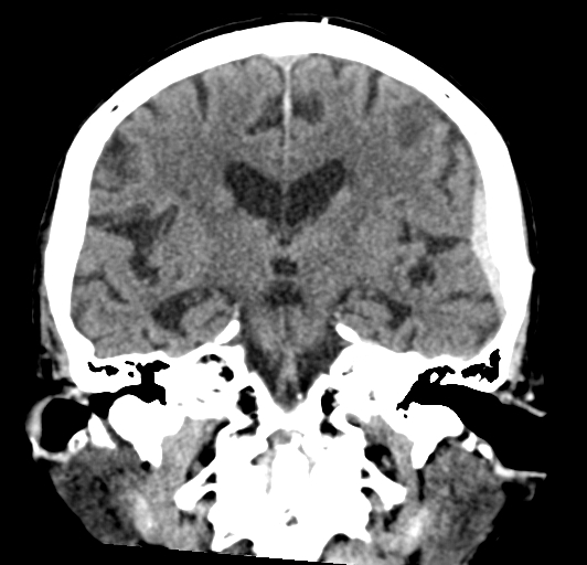 File:Acute traumatic subdural hematoma (Radiopaedia 82921-97257 Coronal non-contrast 48).jpg