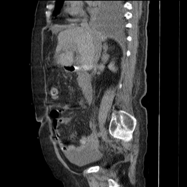 Acute tubular necrosis (Radiopaedia 28077-28334 Sagittal non-contrast 37).jpg