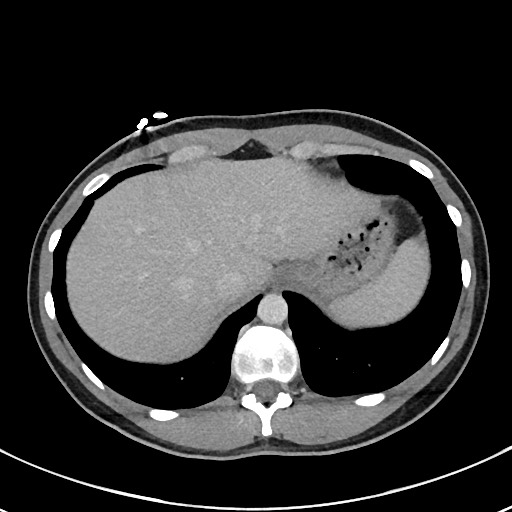 File:Acute uncomplicated appendicitis (Radiopaedia 61374-69304 Axial C+ portal venous phase 15).jpg
