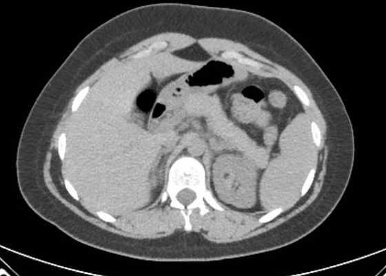 Acute unilateral nonhemorrhagic adrenal infarction (Radiopaedia 67560-76957 Axial non-contrast 31).jpg