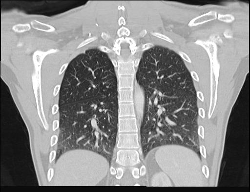 File:Addison disease (Radiopaedia 49318-54412 Coronal lung window 10).jpg
