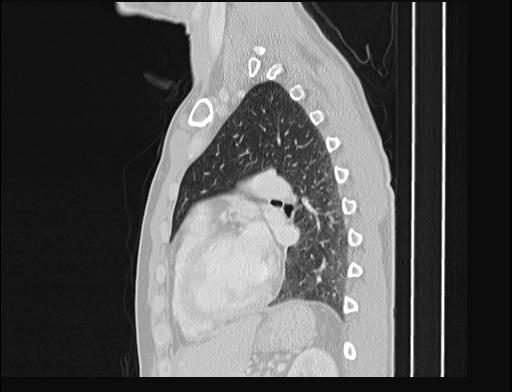 File:Addison disease (Radiopaedia 49318-54412 Sagittal lung window 23).jpg