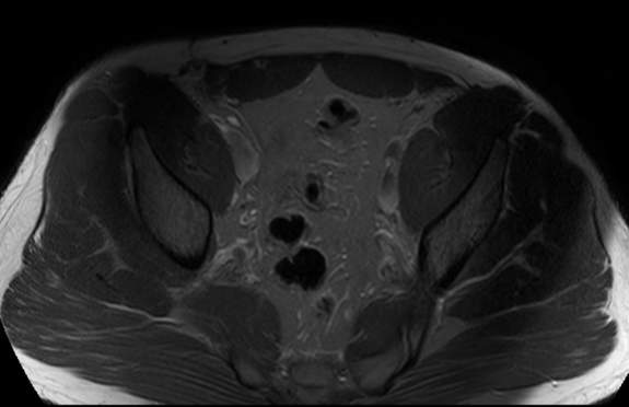 File:Adductor longus tear with retraction (Radiopaedia 56424-63103 Axial T2 fat sat 3).jpg