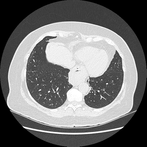 Adenocarcinoma in situ of lung (Radiopaedia 38685-40829 B 169).png