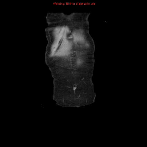 File:Adenocarcinoma of the colon (Radiopaedia 8191-9039 Coronal liver window 3).jpg