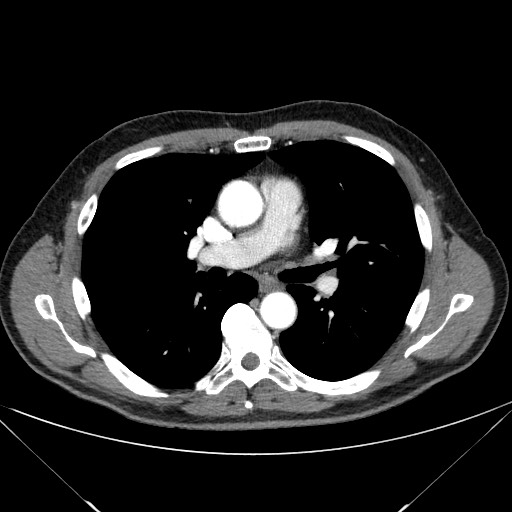 File:Adenocarcinoma of the lung (Radiopaedia 59871-67325 Axial C+ arterial phase 43).jpg