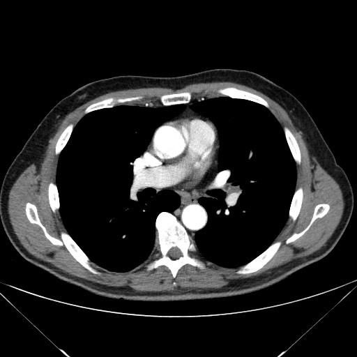 Adenocarcinoma of the lung (Radiopaedia 59871-67325 Axial C+ arterial phase 45).jpg
