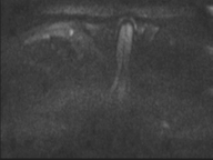 Adenocarcioma of rectum- T1 lesion (Radiopaedia 36921-38546 Axial DWI 61).png