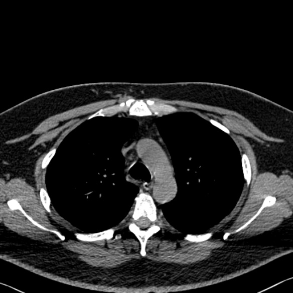 Adenoid cystic carcinoma of the trachea (Radiopaedia 49042-54137 Axial non-contrast 106).jpg
