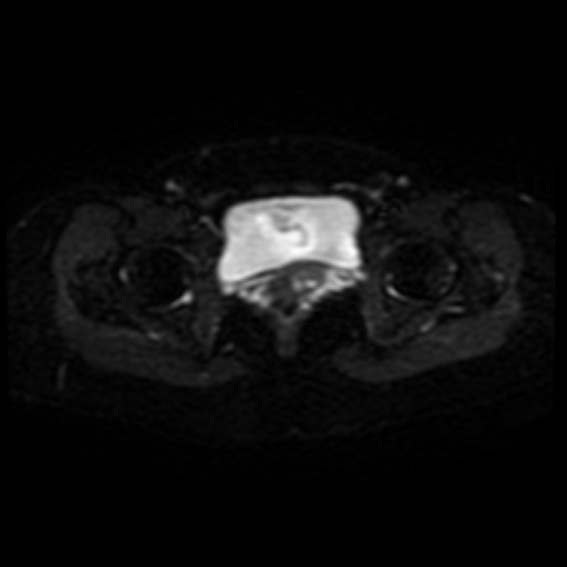 Adenoma malignum of cervix (Radiopaedia 66441-75705 Axial DWI 17).jpg