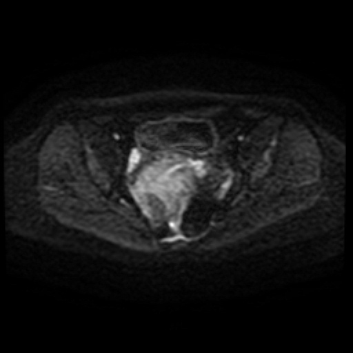 Adenoma malignum of cervix (Radiopaedia 66441-75705 Axial DWI 61).jpg