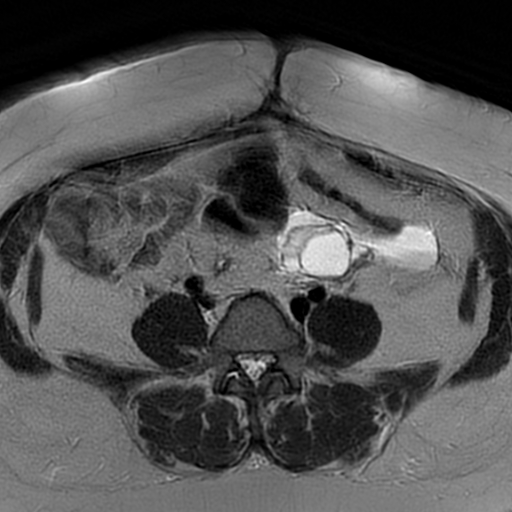 File:Adenomyosis within a didelphys uterus (Radiopaedia 70175-80215 Axial T2 3).jpg