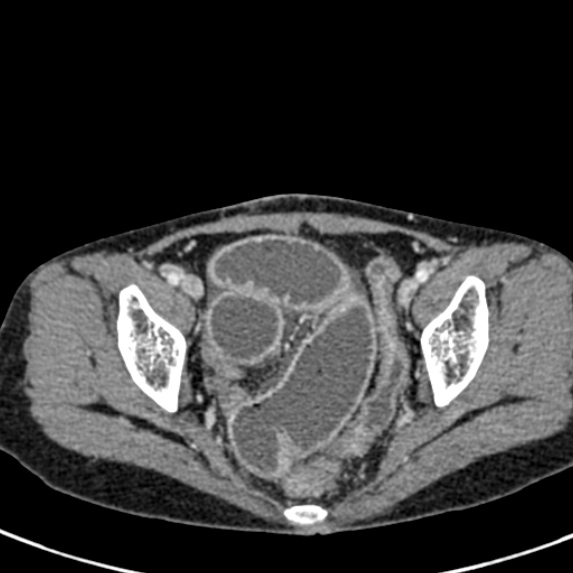 Adhesional small bowel obstruction (Radiopaedia 48397-53305 Axial C+ portal venous phase 81).jpg