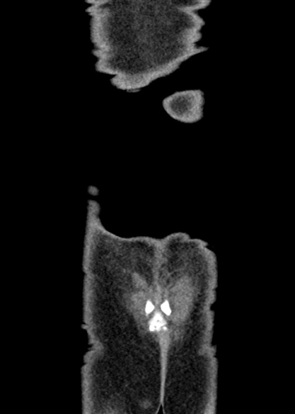 Adhesional small bowel obstruction (Radiopaedia 48397-53305 Coronal C+ portal venous phase 350).jpg