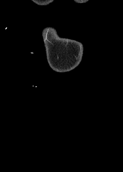 Adhesional small bowel obstruction (Radiopaedia 48397-53305 Coronal C+ portal venous phase 4).jpg