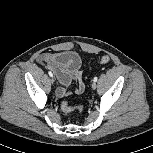 Adhesional small bowel obstruction (Radiopaedia 58900-66131 Axial C+ portal venous phase 45).jpg