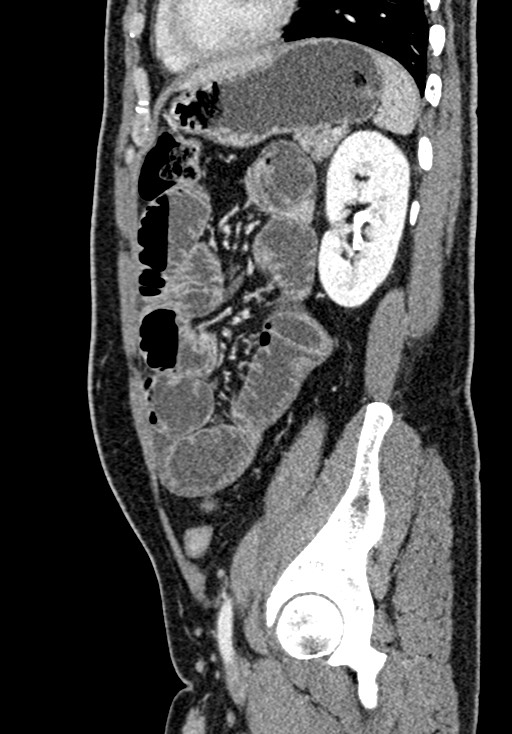Adhesional small bowel obstruction (Radiopaedia 58900-66131 Sagittal C+ portal venous phase 181).jpg