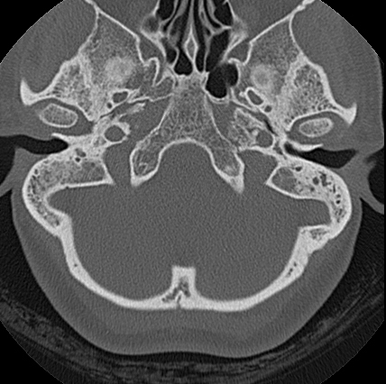 File:Adhesive chronic otitis media (Radiopaedia 14270-14148 Axial bone window 15).jpg