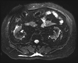 Adrenal cortical carcinoma (Radiopaedia 64017-72770 Axial DWI 25).jpg