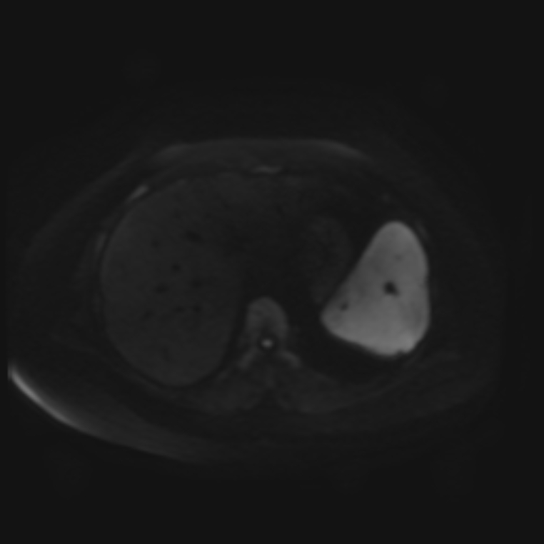 Adrenal cortical carcinoma (Radiopaedia 70906-81116 Axial DWI 35).jpg