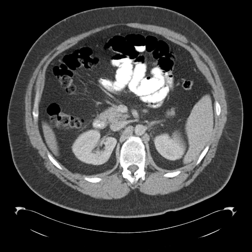 File:Adrenal cyst (Radiopaedia 45625-49776 Axial C+ portal venous phase 36).png