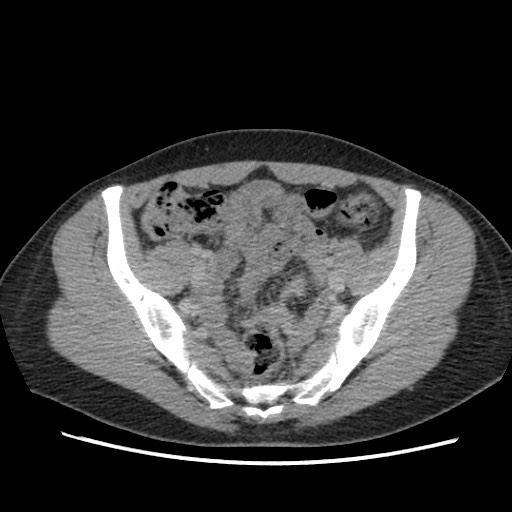 File:Adrenal cyst (Radiopaedia 64869-73813 Axial C+ portal venous phase 63).jpg