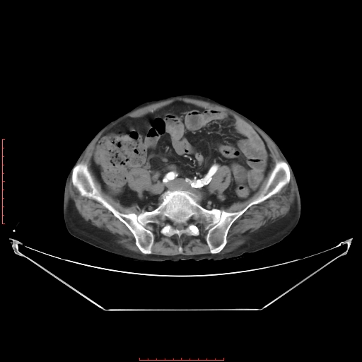 Adrenal hemangioma (Radiopaedia 68923-78668 Axial C+ arterial phase 53).jpg