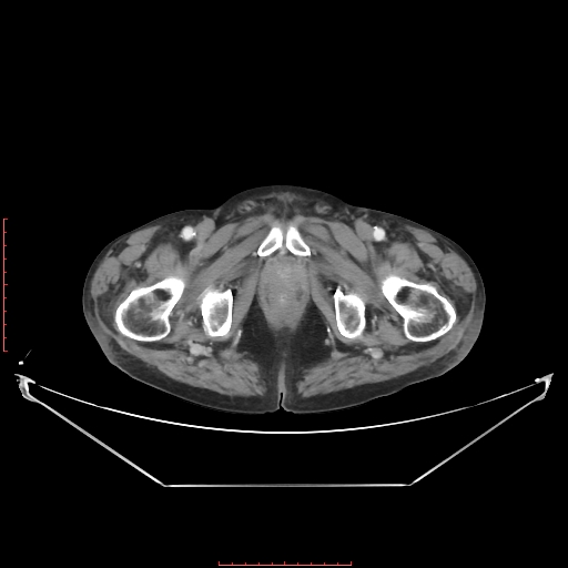 File:Adrenal hemangioma (Radiopaedia 68923-78668 Axial C+ portal venous phase 73).jpg