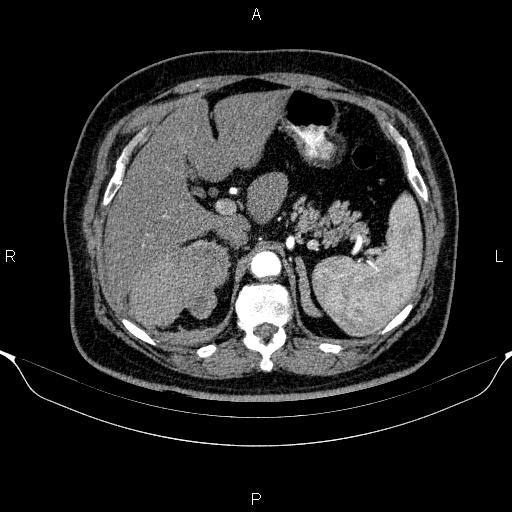 Adrenal hemorrhage (Radiopaedia 62622-70916 Axial C+ arterial phase 101).jpg
