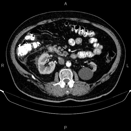 Adrenal hemorrhage (Radiopaedia 62622-70916 Axial C+ arterial phase 174).jpg