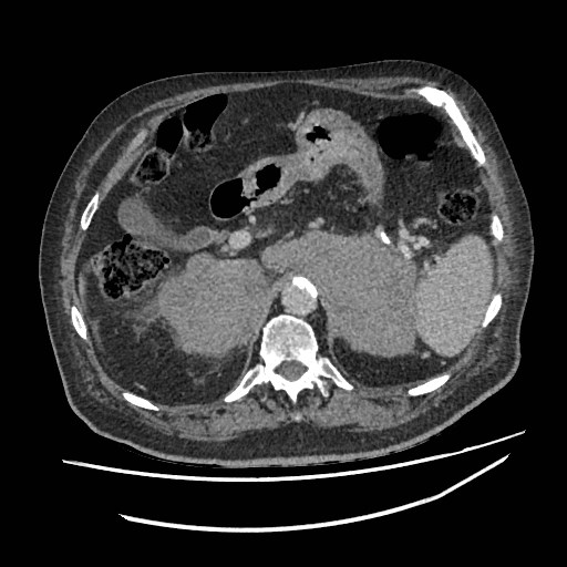 Adrenal lymphoma (Radiopaedia 84145-99415 Axial C+ portal venous phase 28).jpg