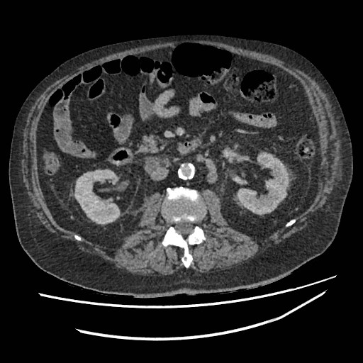 Adrenal lymphoma (Radiopaedia 84145-99415 Axial C+ portal venous phase 62).jpg