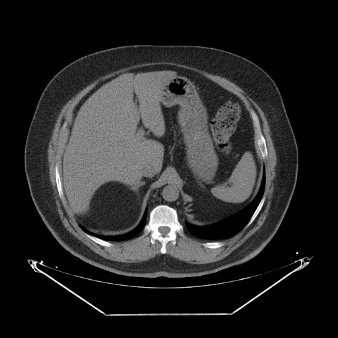 Adrenal myelolipoma (Radiopaedia 26278-26407 Axial non-contrast 13).jpg