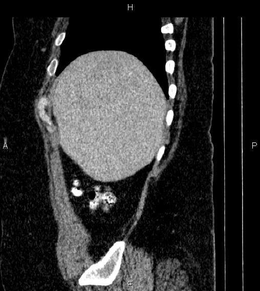 File:Adrenal myelolipoma (Radiopaedia 84319-99617 Sagittal renal cortical phase 12).jpg