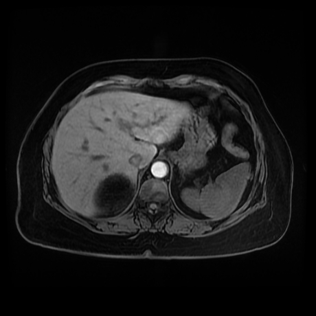 Adrenal myelolipoma - MRI (Radiopaedia 83249-97646 Axial T1 fat sat 13).jpg