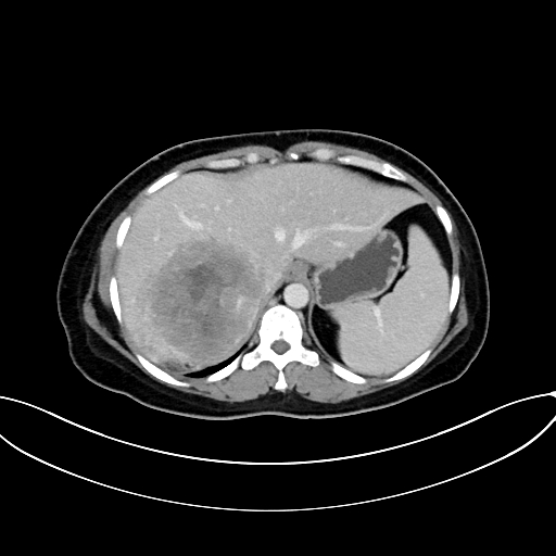 Adrenocortical carcinoma (Radiopaedia 87281-103569 Axial C+ portal venous phase 18).jpg