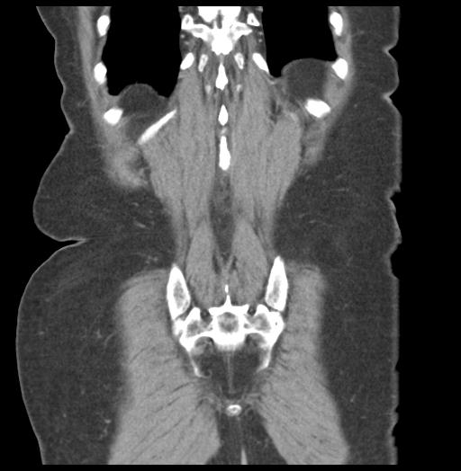 Adult ileal intussusception with secondary obstruction (Radiopaedia 30395-31051 Coronal C+ portal venous phase 55).jpg