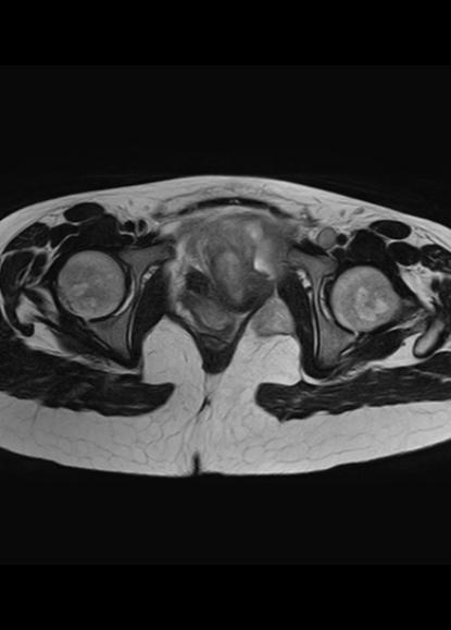 File:Aggressive angiomyxoma of the pelvis and perineum (Radiopaedia 59162-66479 Axial T2 6).jpg